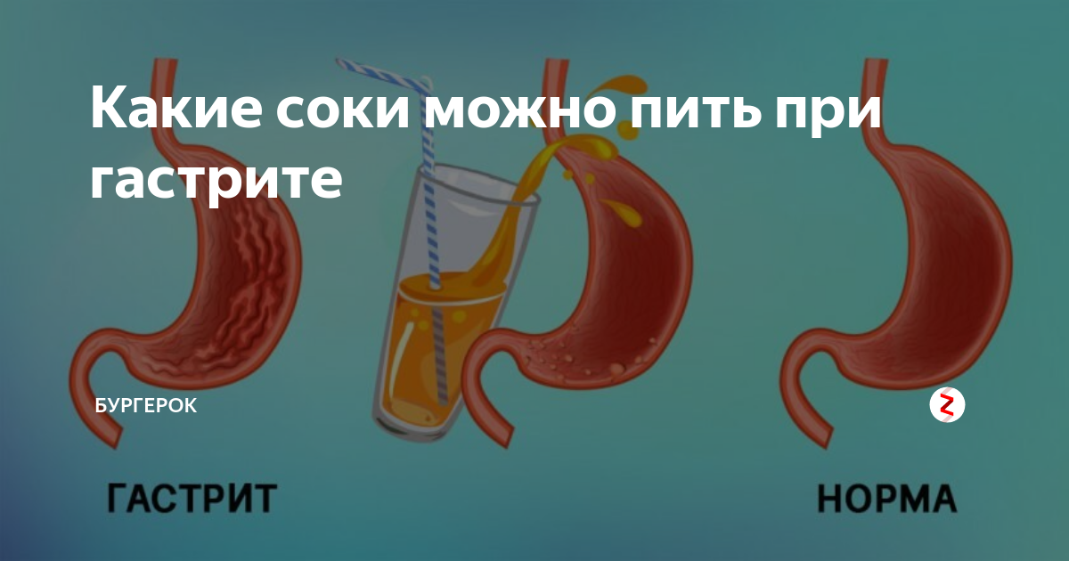 Какие соки можно пить. Какой сок можно при гастрите. Соки при гастрите. Какие соки можно пить при гастрите. Желудочный сок при гастрите