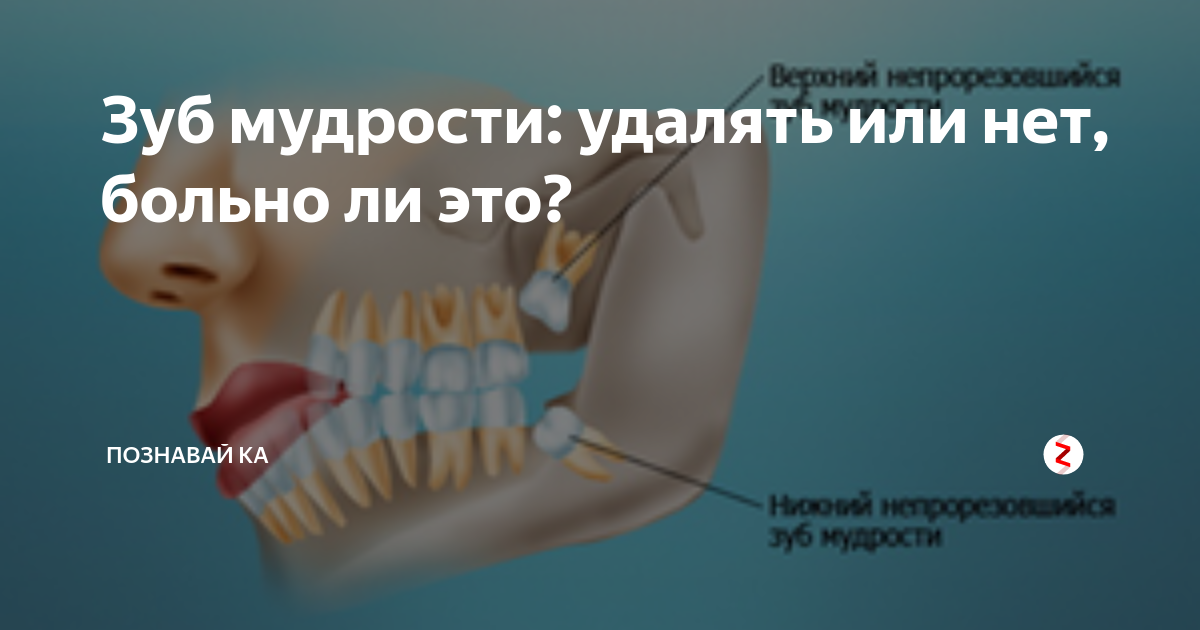 Удали 8. Зубы мудрости где расположены. Зуб мудрости какой по счету. Больно ли удалять зуб мудрости.