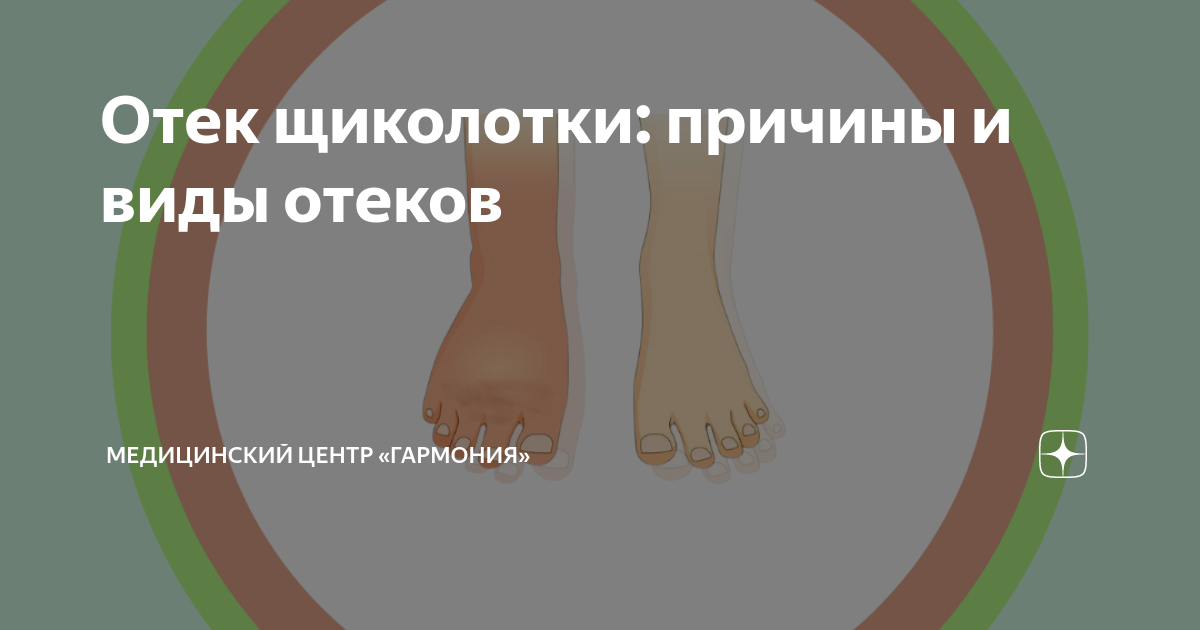 Отек щиколотки: причины и виды отеков | Медицинский центр «Гармония» | Дзен