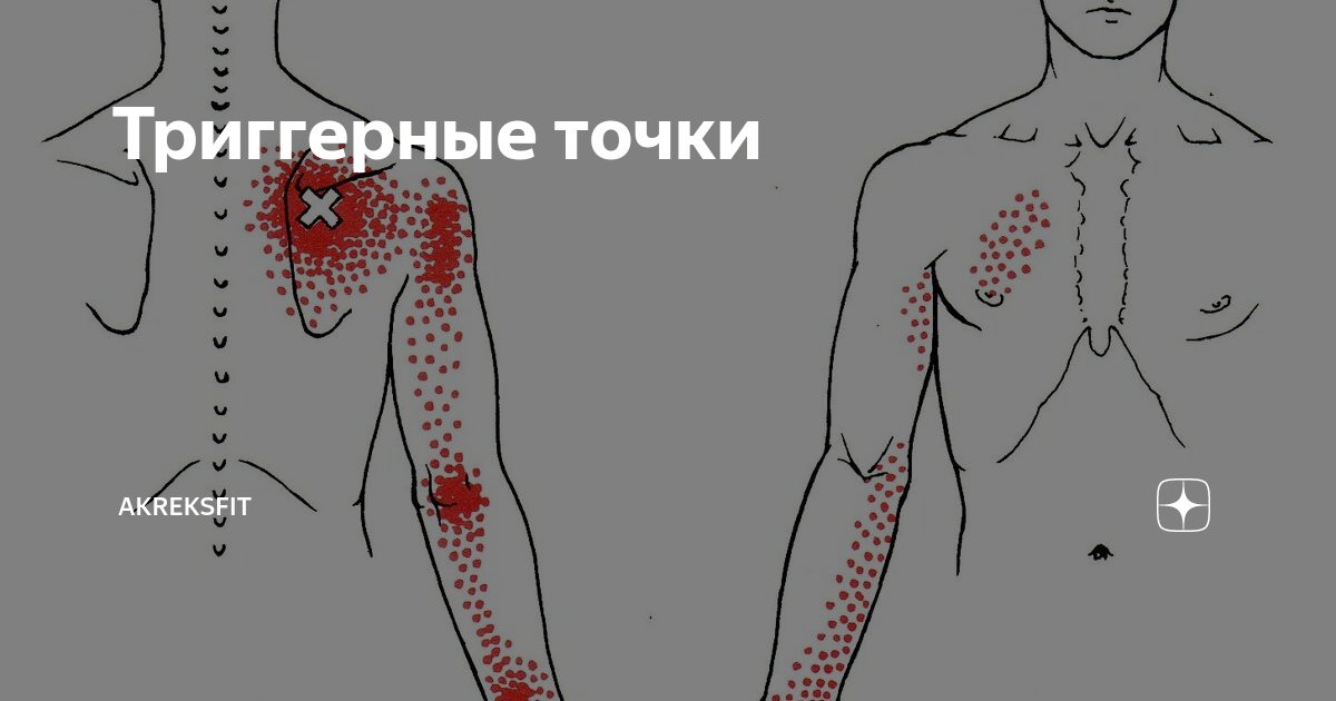 Триггерные точки | Анастасия Крекова | фитнес тренер | Дзен