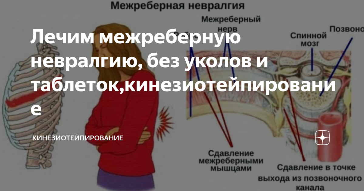 Таблетки от межреберной невралгии список лучших. При межреберной невралгии. Межреберная невралгия лекарства. Неврология межреберная симптомы. Неврология межреберная невралгия симптомы.