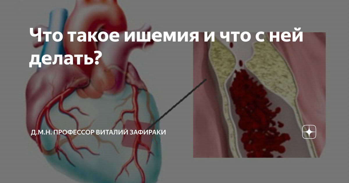 Что такое ишемия и что с ней делать? | Кардиолог, д.м.н. Виталий ...