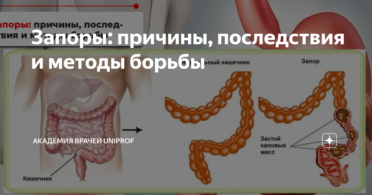 Запоры: причины, последствия и методы борьбы | Академия врачей UniProf ...