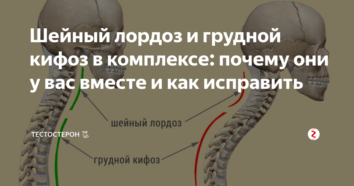 Как исправить шейный отдел. Шейный лордоз. Исправление шейного лордоза. Шейный лордоз выпрямлен с кифотической деформацией.