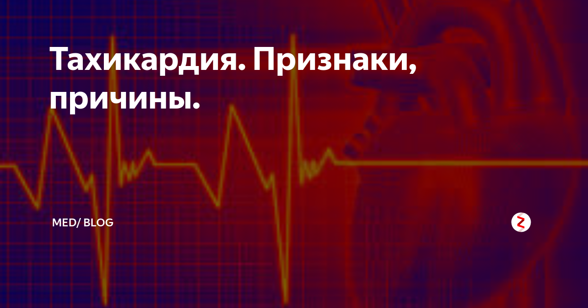 Синусовая тахикардия и брадикардия. Синусовая тахикардия на экг. Чсс 150 на экг с синусовым ритмом. Ритм синусовый. Пароксизмальная суправентрикулярная тахикардия клиника.