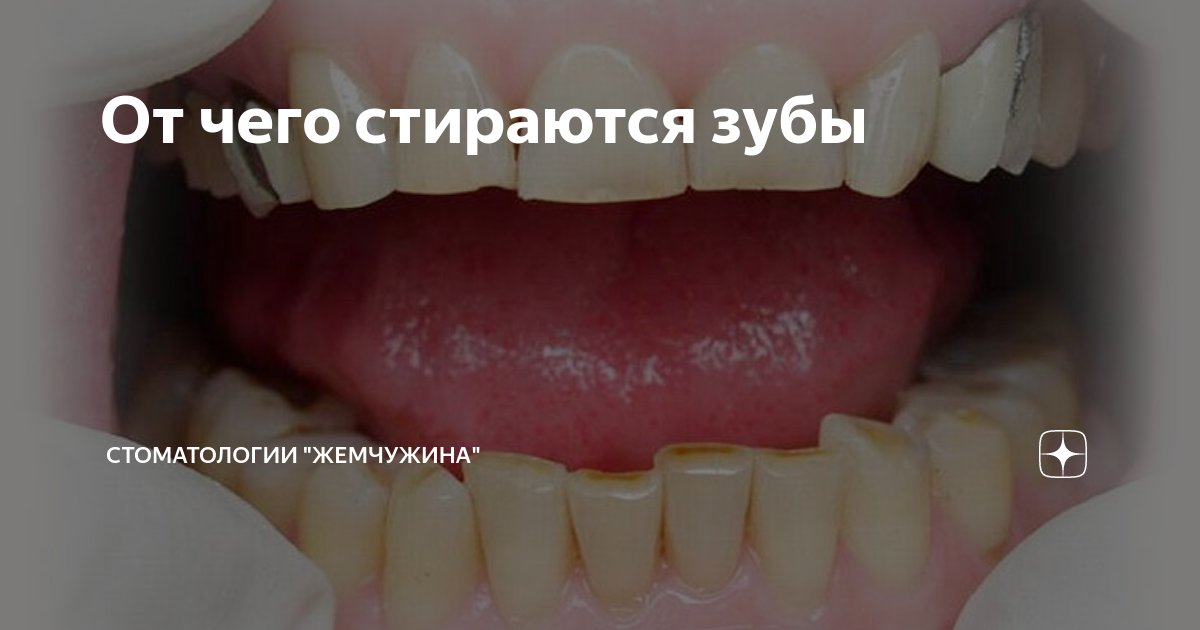 От чего стираются зубы | Стоматология "Жемчужина" | Дзен