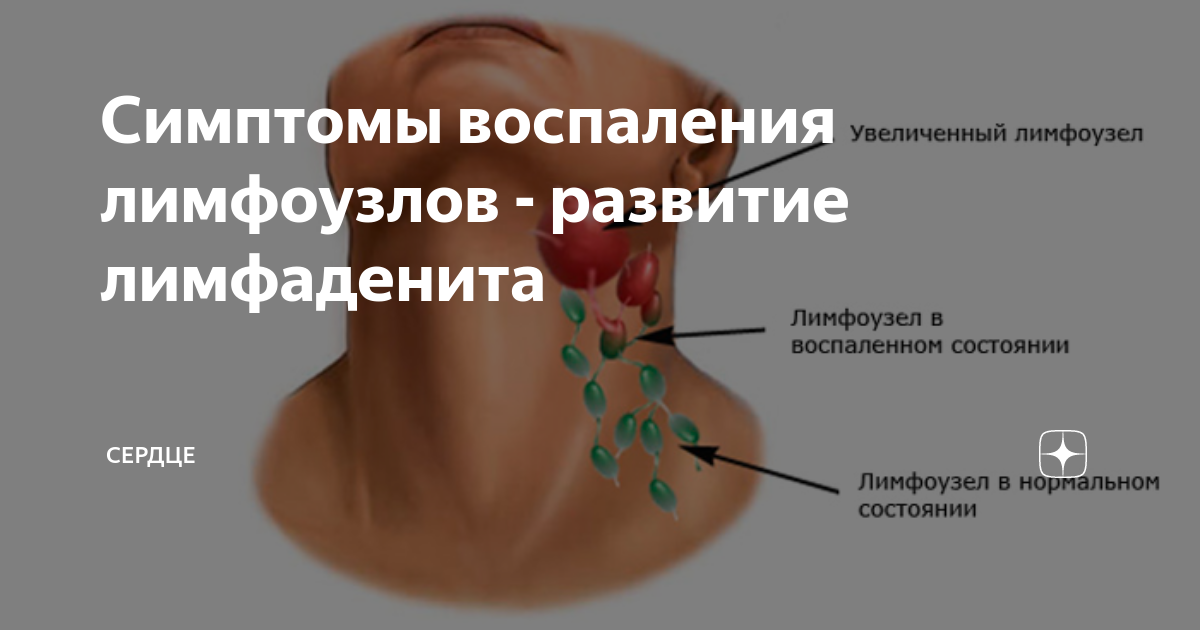 Воспаление лимфоузлов