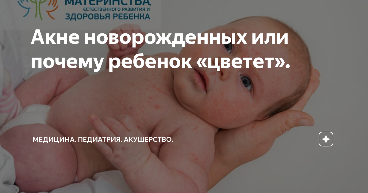 Что такое цветение у новорожденного ребенка: что делать, сколько длится и почему