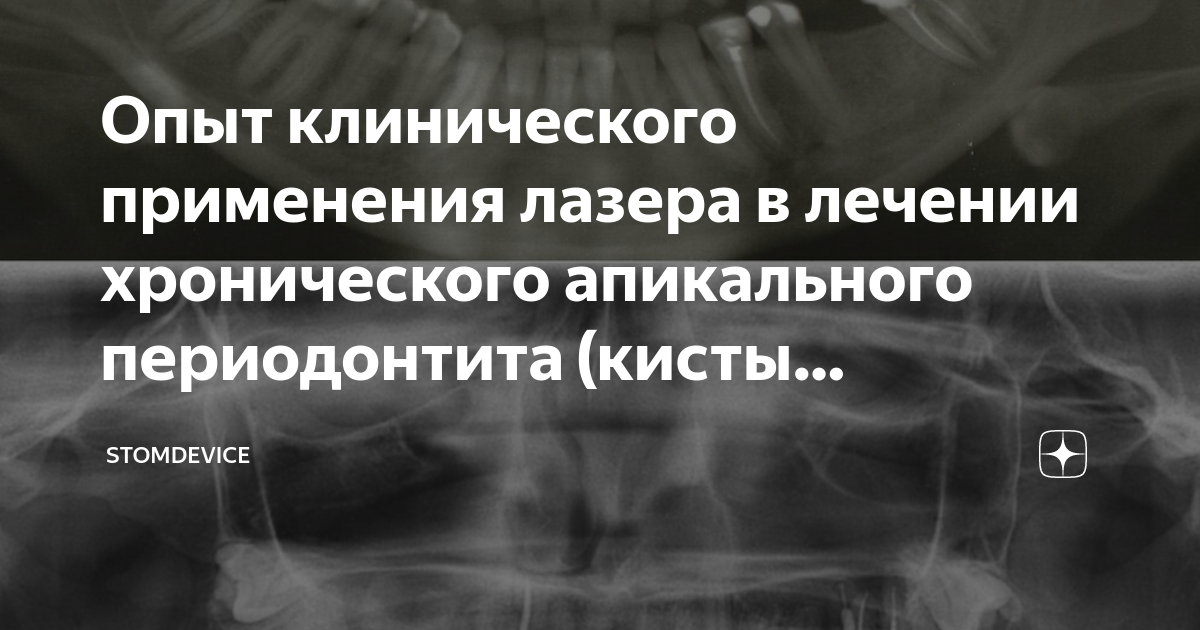 лечение хронического апикального периодонтита