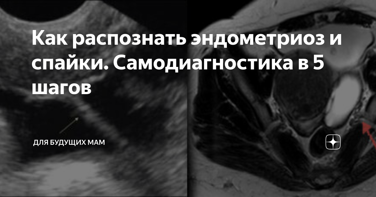 Как распознать эндометриоз и спайки. Самодиагностика в 5 шагов | для ...