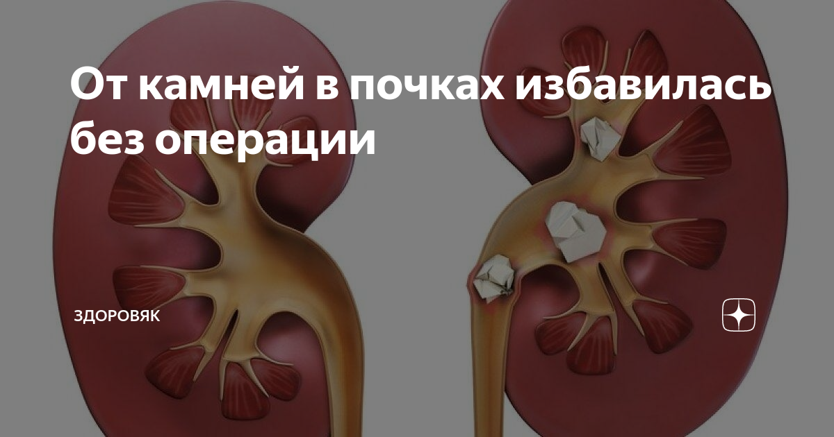 Камни в почках и желчном пузыре.