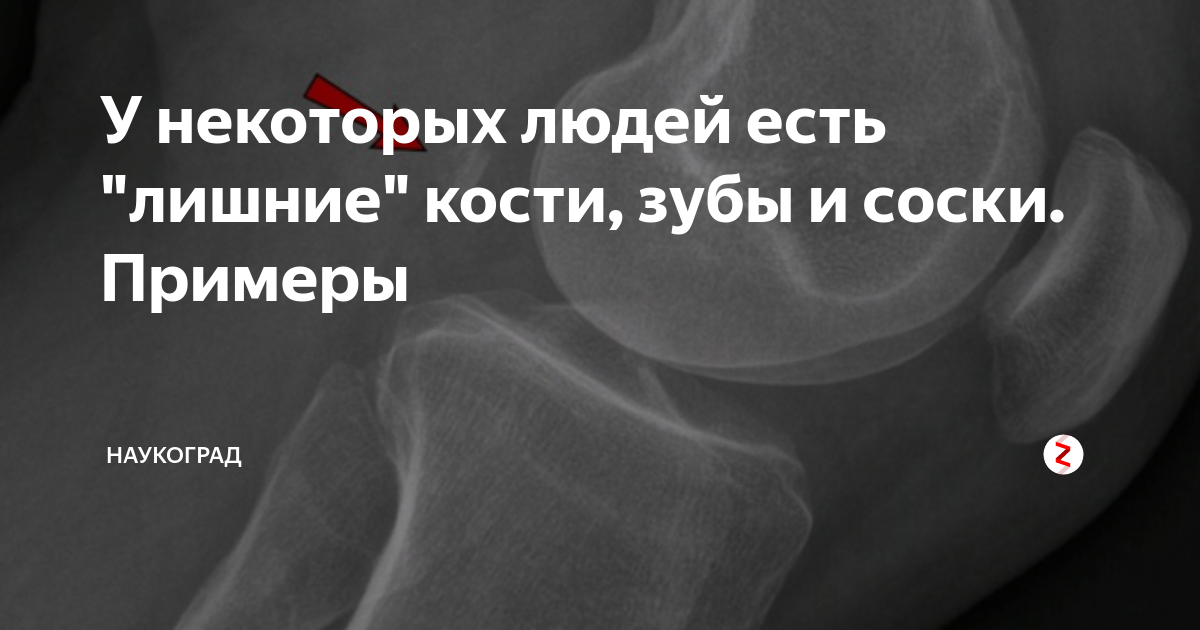 У некоторых людей есть "лишние" кости, зубы и соски. Примеры ...