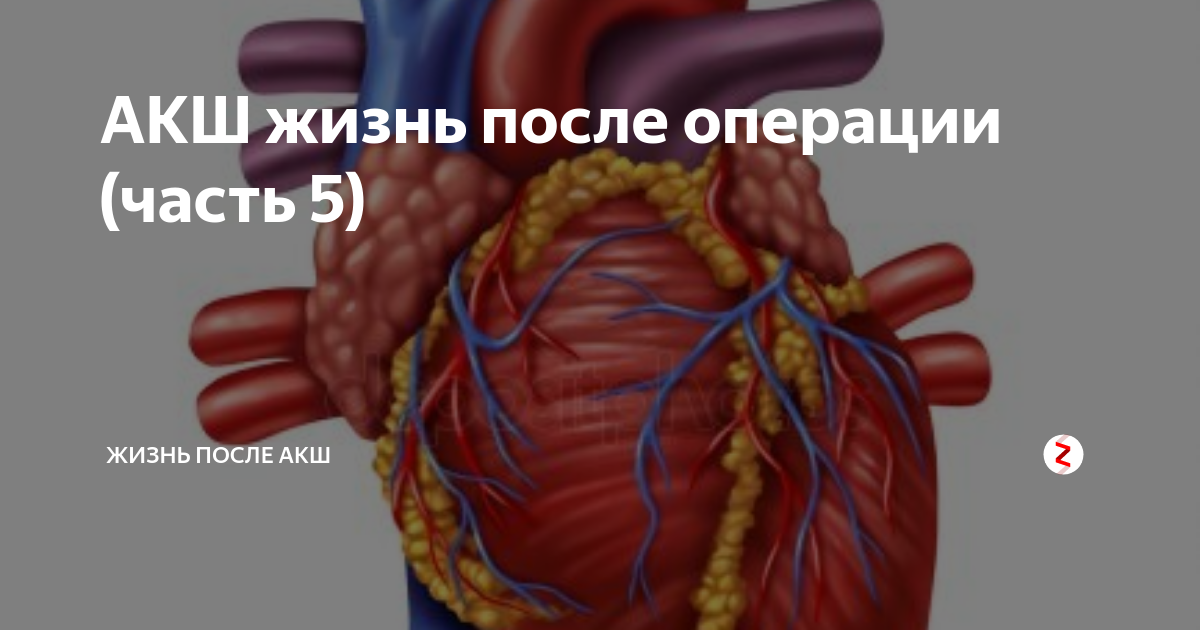 Акш. АКШ после операции год. Жизнь после АКШ на сердце. Одежда после операции АКШ.