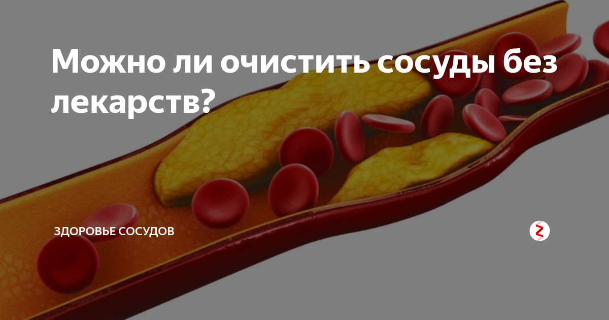 Можно ли убрать бляшку. Холестериновые бляшки в сосудах. Растворение холестериновых бляшек.