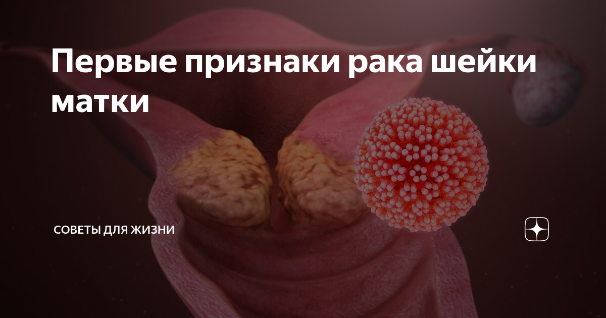Рак матки на ранних стадиях. Раковые клетки шейки матки. Злокачественные заболевания женских половых органов. Онкология матки симптомы.