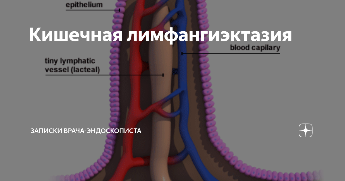 Лимфангиэктазия. Лимфангиэктазии кишечника. Лимфангиоэктазия 12 перстной кишки.