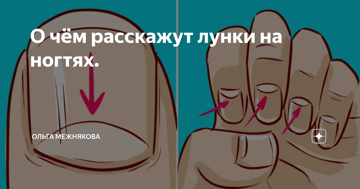 Лунки на ногтях значение для здоровья человека. Лунки на ногтях здорового человека. Болезни по лункам на ногтях. Лунки на ногтях значение для здоровья. Лунки на ногтях значение для здоровья.