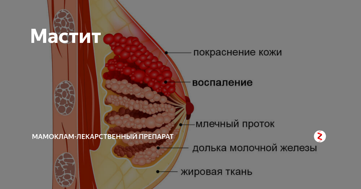 Мастит – причины, симптомы, диагностика и лечение заболевания в клинике «Будь Здоров»