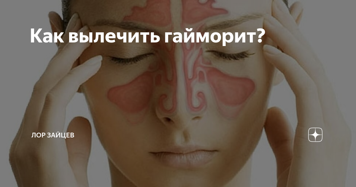 Гайморовы пазухи гайморит. Народные методы от гайморита. Хронический гайморит клиника. Вылечить синусит навсегда. Формы хронического синусита.