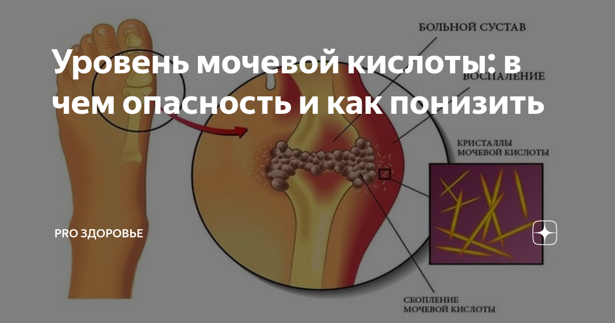 Какие продукты снижают мочевую кислоту в организме. Скопление мочевой кислоты. Накапливание мочевой кислоты в организме. Мочевая кислота влияет на суставы. Скопление мочевой кислоты в суставах.