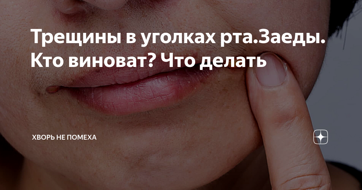 Постоянно появляются заеды в уголках губ? Расскажем почему и как их лечить