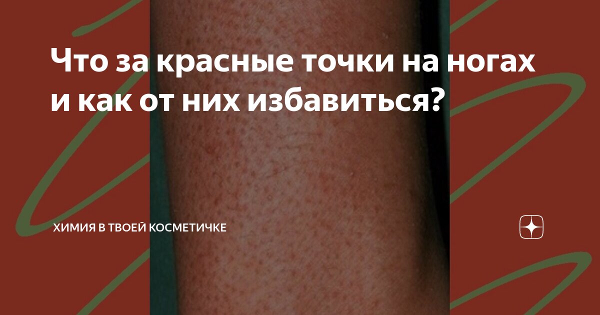 как избавиться от красных точек после бритья на ногах