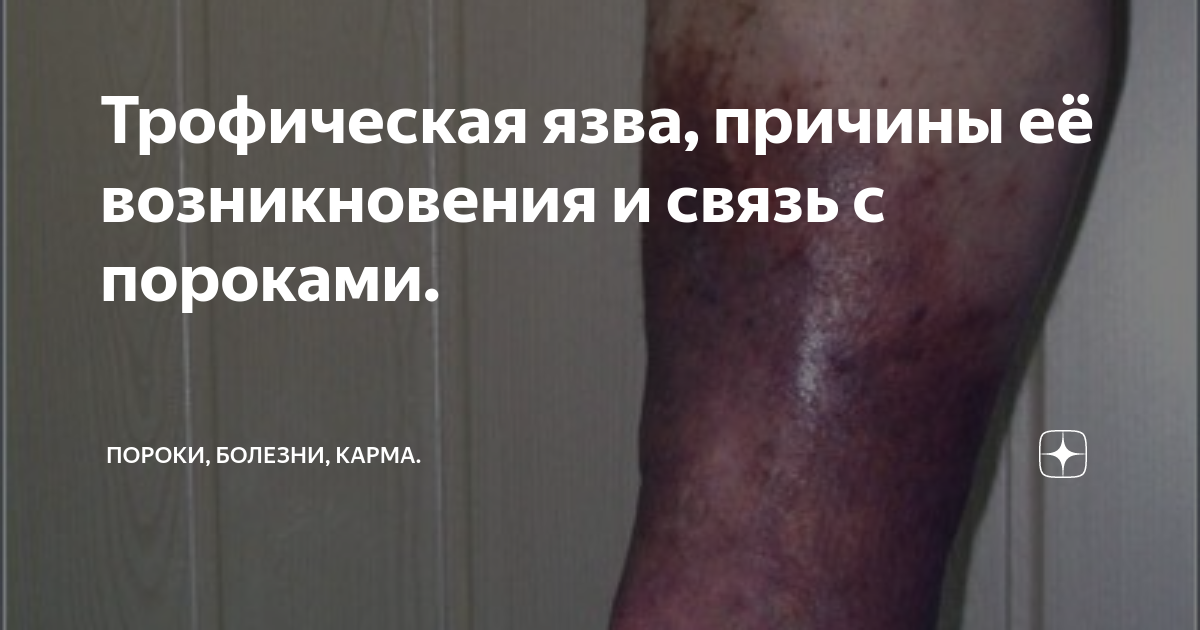 Трофическая язва, причины её возникновения и связь с пороками. | Пороки ...