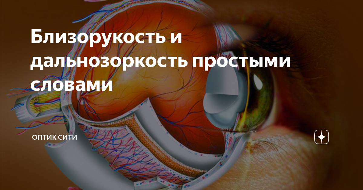 Близорукость и дальнозоркость простыми словами | Оптик Сити | Дзен