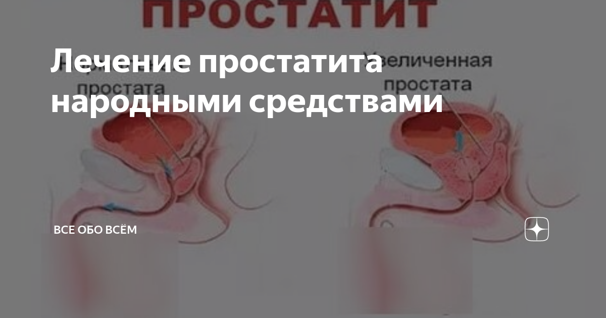 Хронический простатит: причины, симптомы, народные средства для лечения и медицинский взгляд