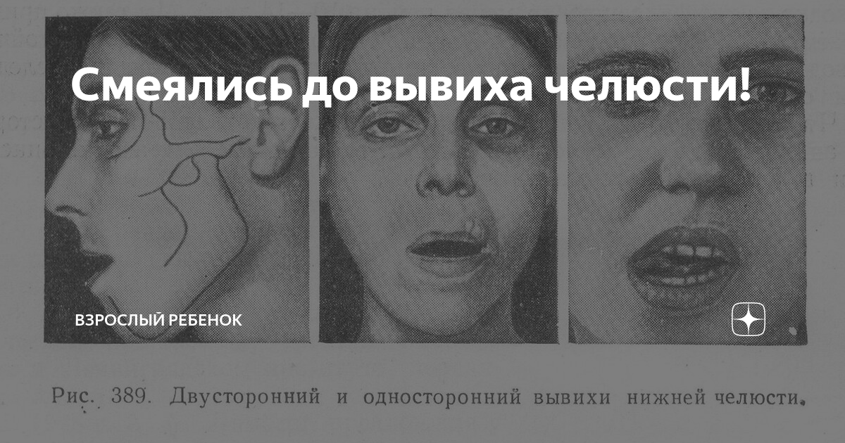 Подвывих челюсти симптомы. Подвывих челюсти симптомы. Метод вправления вывиха нижней челюсти. Подвывих челюсти симптомы. Метод блехмана-гершуни.