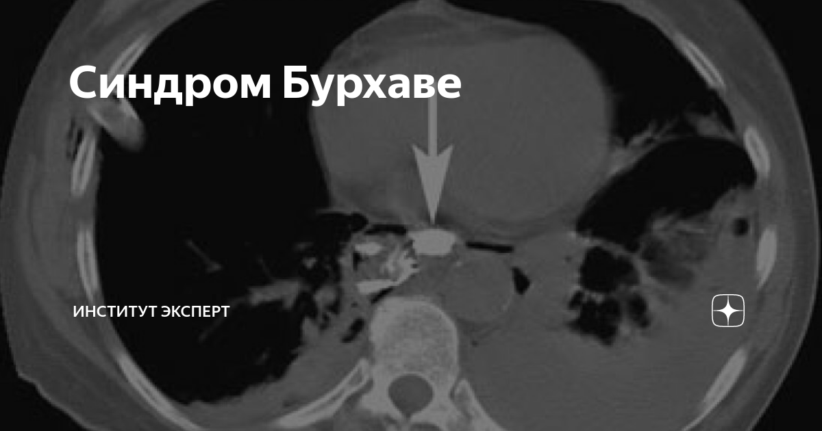 спонтанный разрыв пищевода