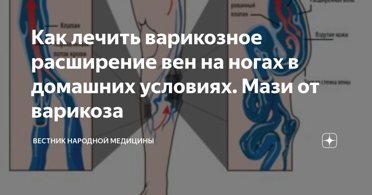Торчат вены на ногах лечение в клинике Петербурга