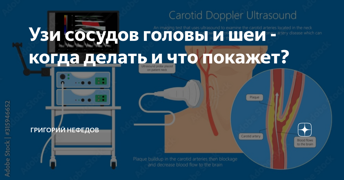 Ультразвуковое исследование брахиоцефальных артерий. Узи сосудов орск. Узи сосудов головного. Врач узи или врач уздг. Швец узи пенза.