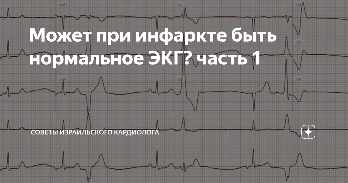 Может при инфаркте быть нормальное ЭКГ? часть 1 | Советы израильского ...