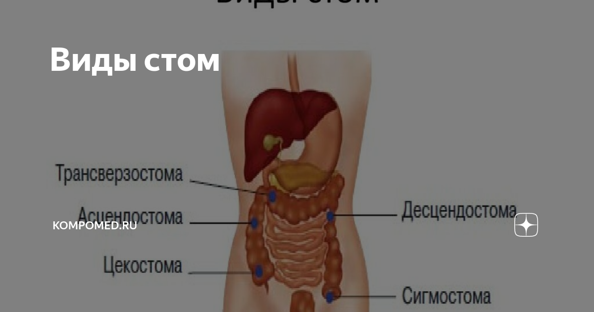 Виды стом | kompomed.ru | Дзен