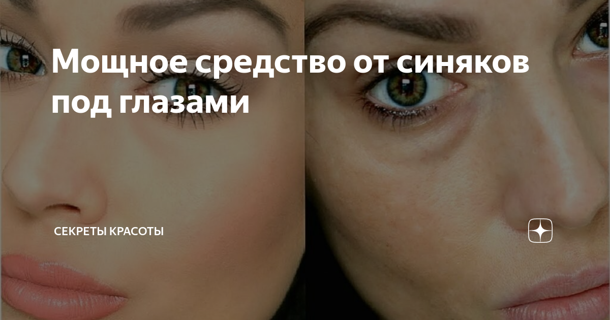 Как быстро снять синяк Как быстро убрать фингал под глазом в домашних условиях