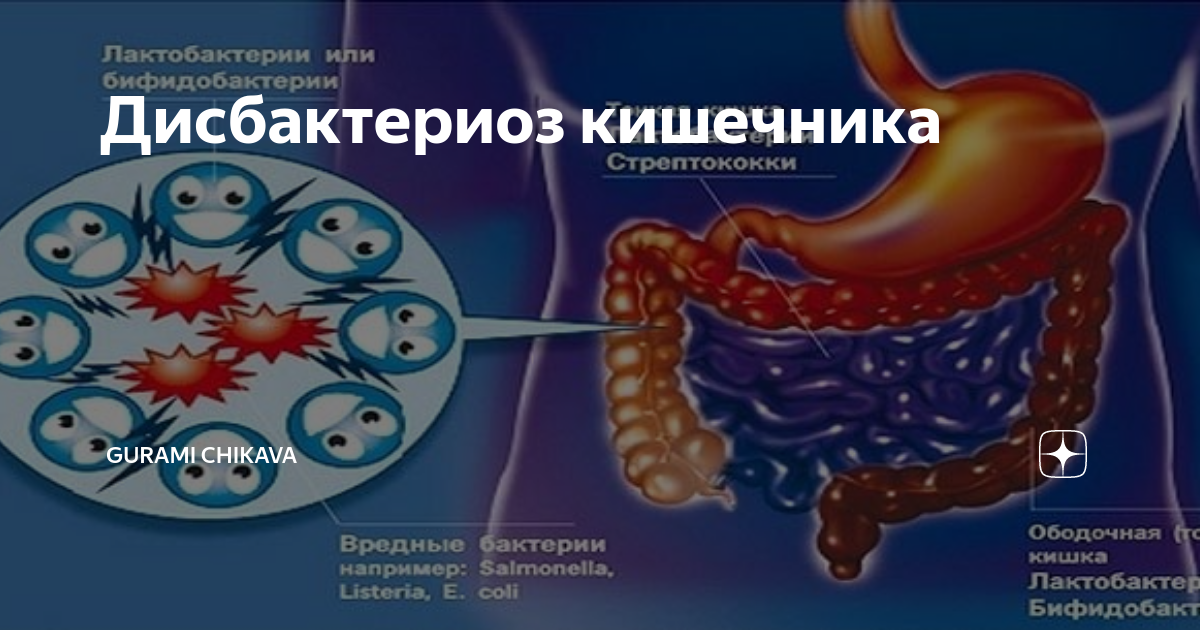 Дисбактериоз кишечника презентация