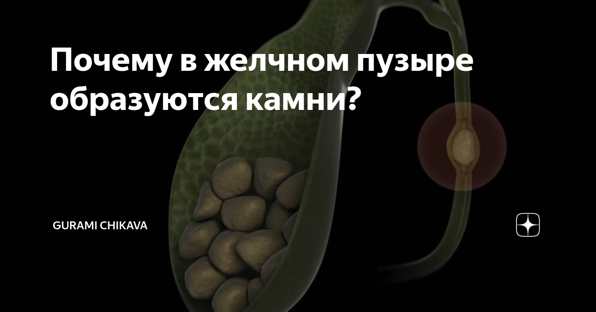 Причины образования камней в желчном пузыре. В желчном пузыре образуются камни. Камни в жёлчном пузыре причины. Растворение камней в желчном пузыре.