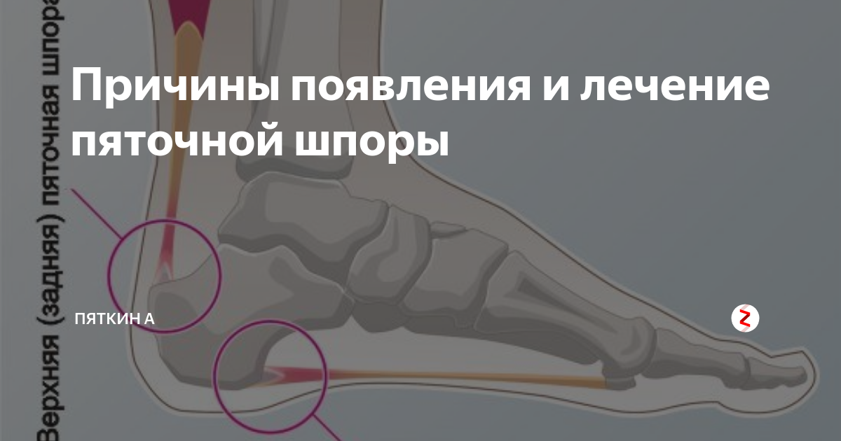 Шпора на пятке симптомы и лечение. Причины возникновения пяточных шпор. Шпора причины возникновения. Пяточная шпора причины. Причина появления шпоры