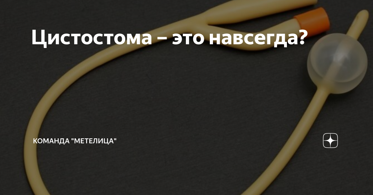 Тренировка мочевого при цистостоме. Цистостома мочевого пузыря у мужчин описание. Цистостома это навсегда или нет.