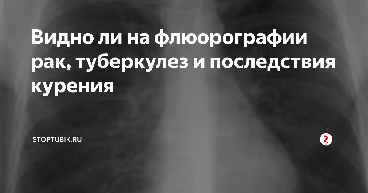 Видно ли на флюорографии что человек курит электронные сигареты