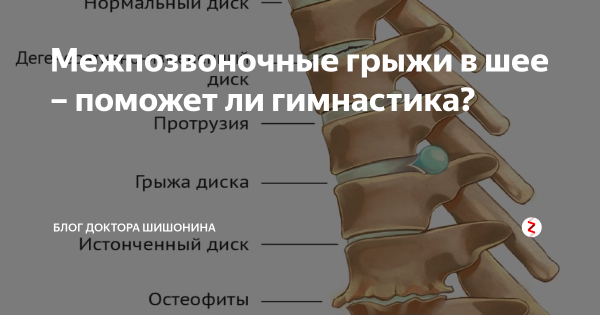 Протрузии шейного отдела позвоночника. Шея грыжа гимнастика. Выпячивание межпозвонковой грыжи шея. Упражнения при протрузии шейных позвонков
