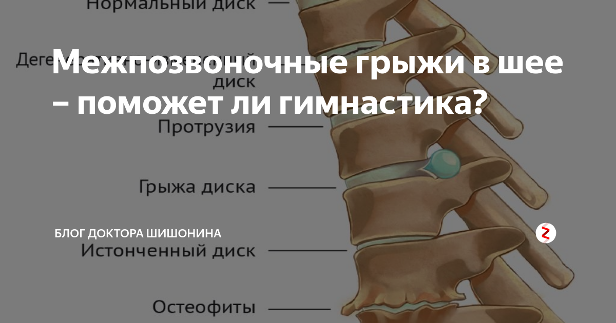 Протрузии шейного отдела что делать