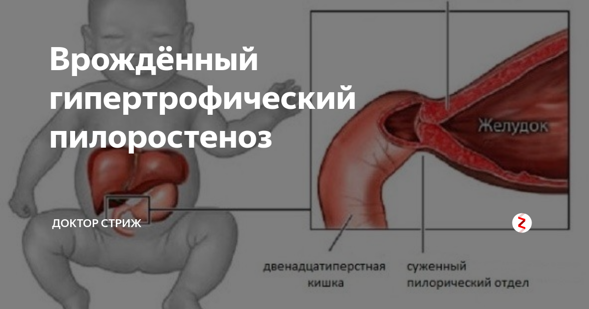 Характер стула при пилоростенозе