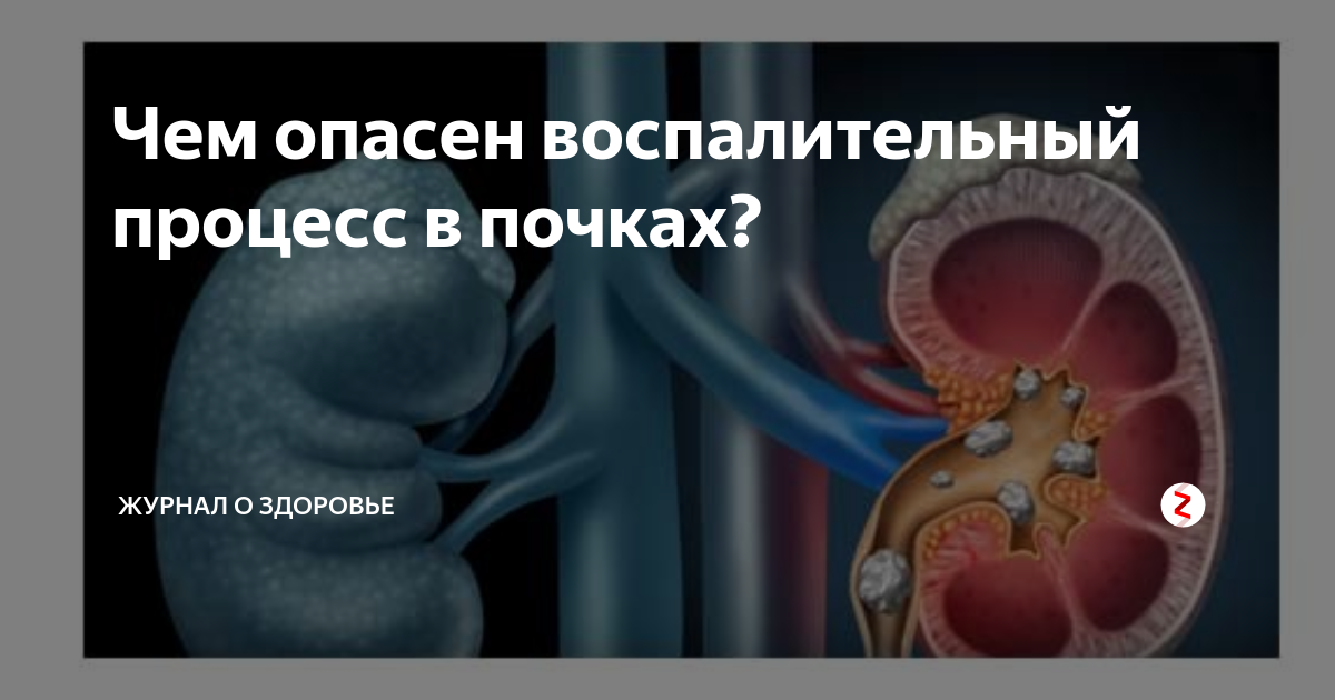 Воспалительный процесс в почках. Воспаление лоханки почки. Воспаление почечной лоханки. Воспалительный процесс в почке картинки. Слизистые оболочки почек