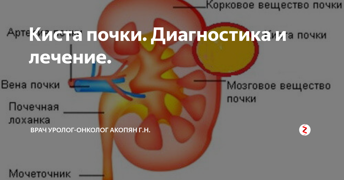 Киста в почке лечение у взрослых женщин. Кистозное образование левой почки.