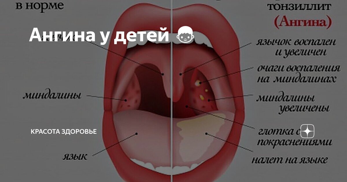 Симптомы молочницы у детей