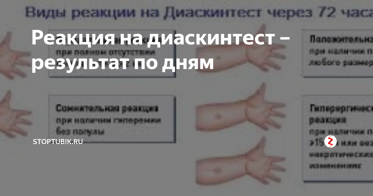 Как должна выглядеть реакция диаскинтест Диаскинтест результат 9 ответов форум Babyblog