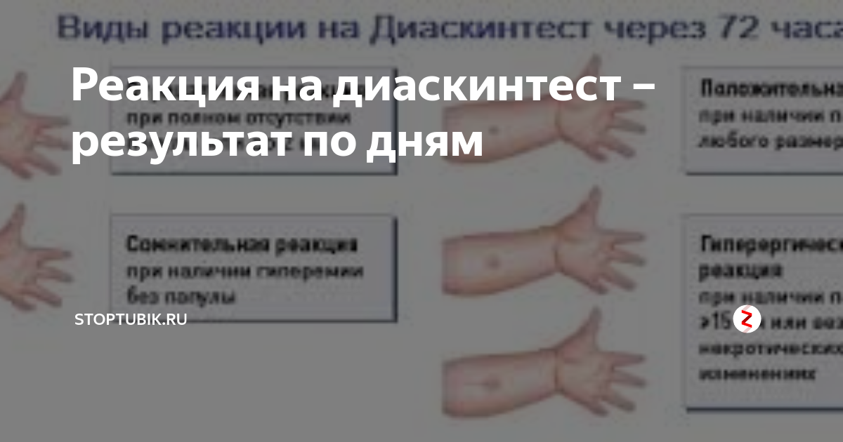 Диаскинтест для выявления туберкулеза