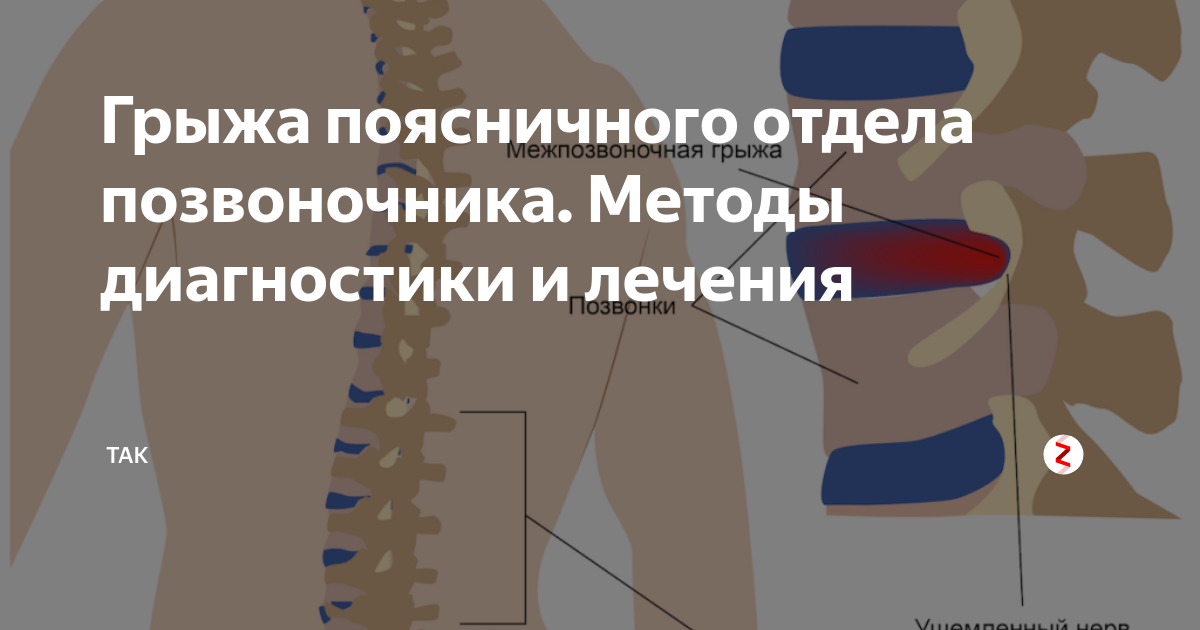 Симптомы поясничной грыжи. Грыжа позвоночника симптомы. Грыжа грудного отдела позвоночника. Межпозвоночная грыжа грудного отдела позвоночника. Межпозвоночная грыжа грудного отдела симптомы.